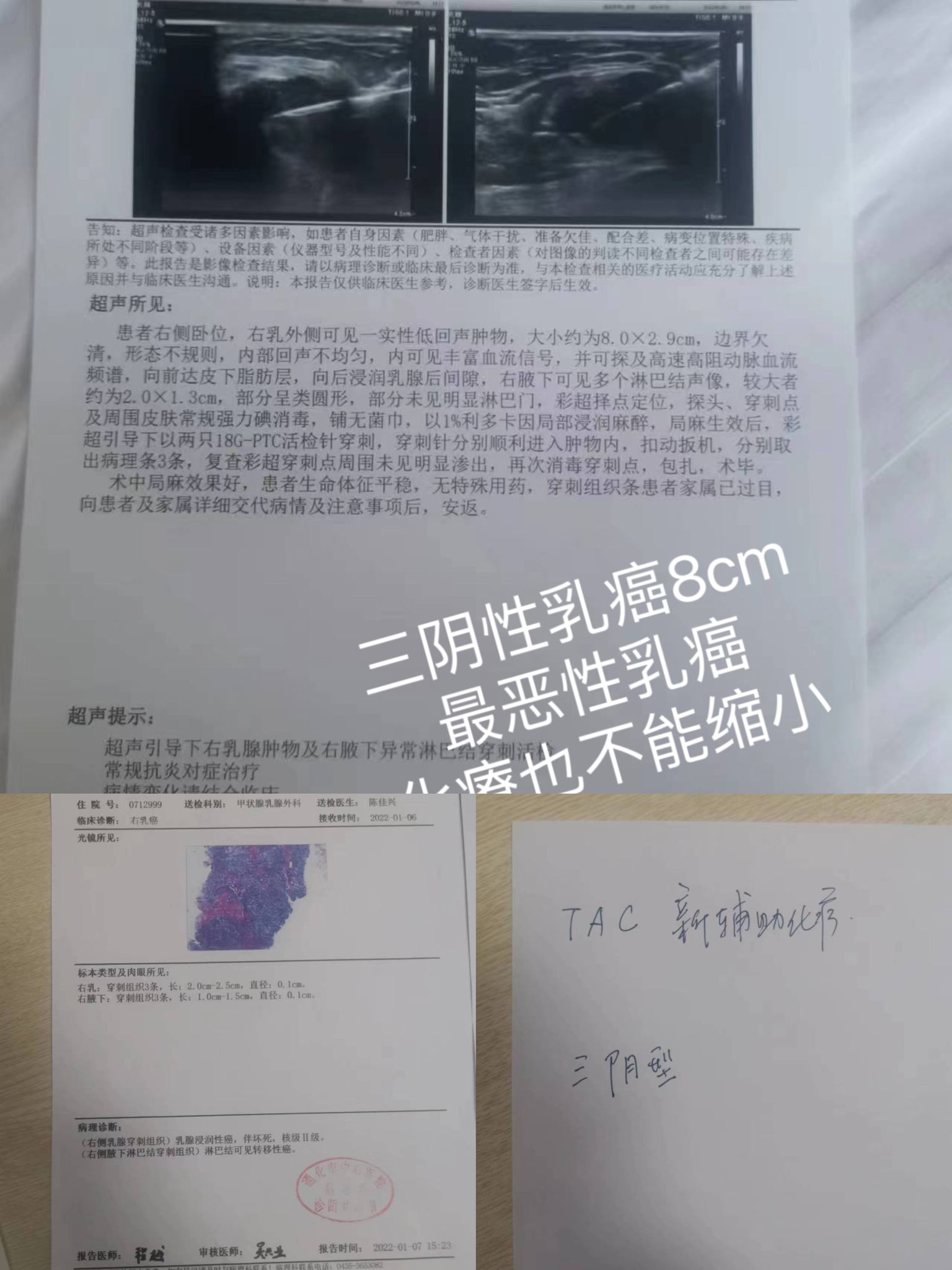 癌症